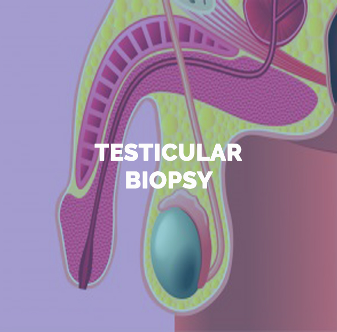 biopsia testicular